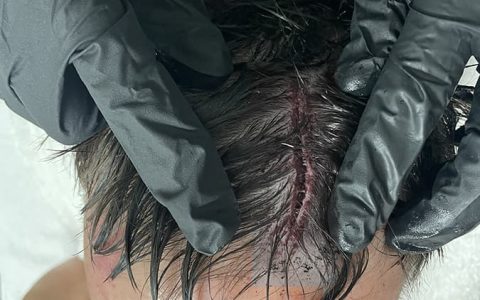 芬巴洛尔头部受伤照片曝光