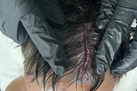 芬巴洛尔头部受伤照片曝光