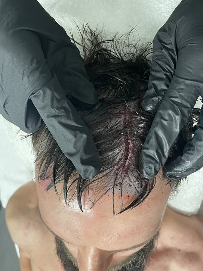 芬·巴洛尔回顾与艾吉比赛中的血腥失误，差点被医生用订书机订头