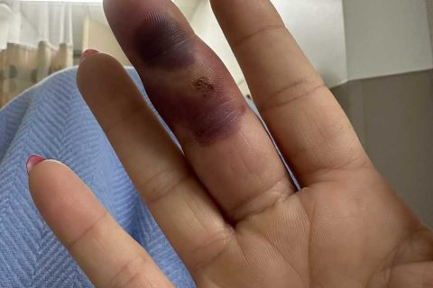 前WWE明星拉娜手指感染后续，手术后发布触目惊心的照片