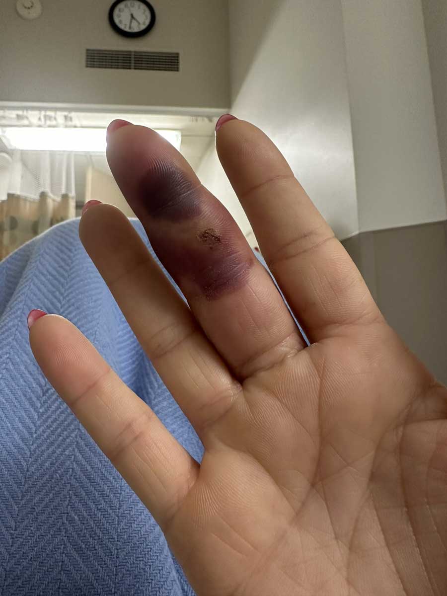前WWE明星拉娜手指感染后续,手术后发布触目惊心的照片