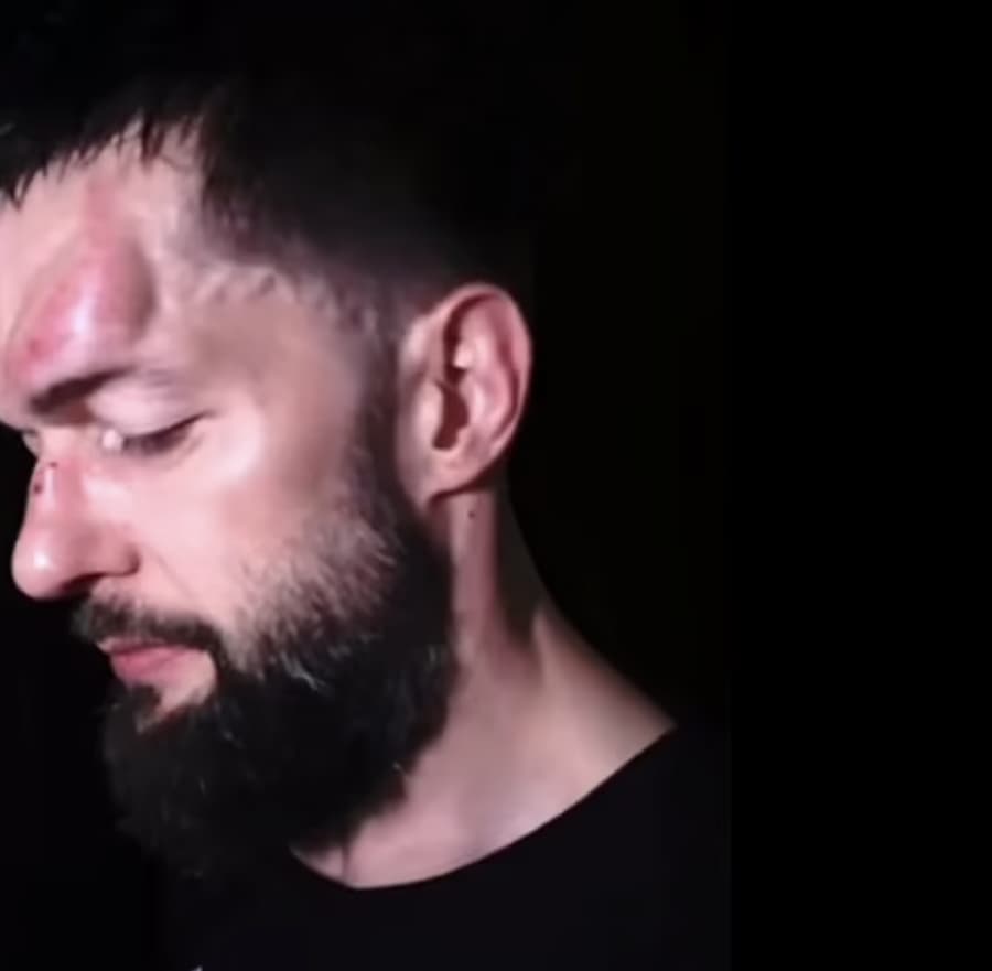 前WWE冠军意外受伤，头部肿的像石头一样！